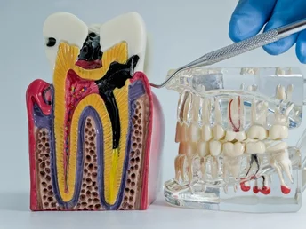 denizli kanal tedavisi (endodonti)