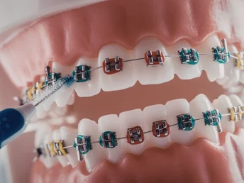 denizli ortodonti (diş teli)